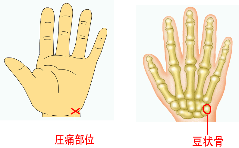 尺骨突き上げ症候群S-HANDクリニック 埼玉県さいたま市 手外科