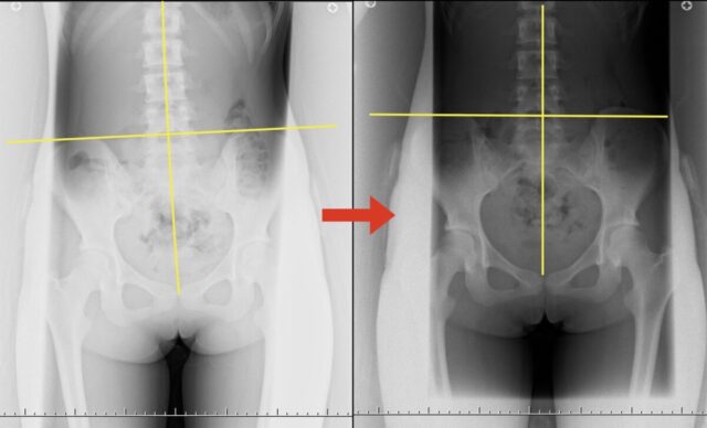 側弯症上高田ちば整形外科・小児科