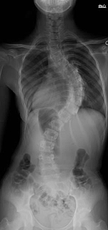 脊柱側弯症について 横浜市