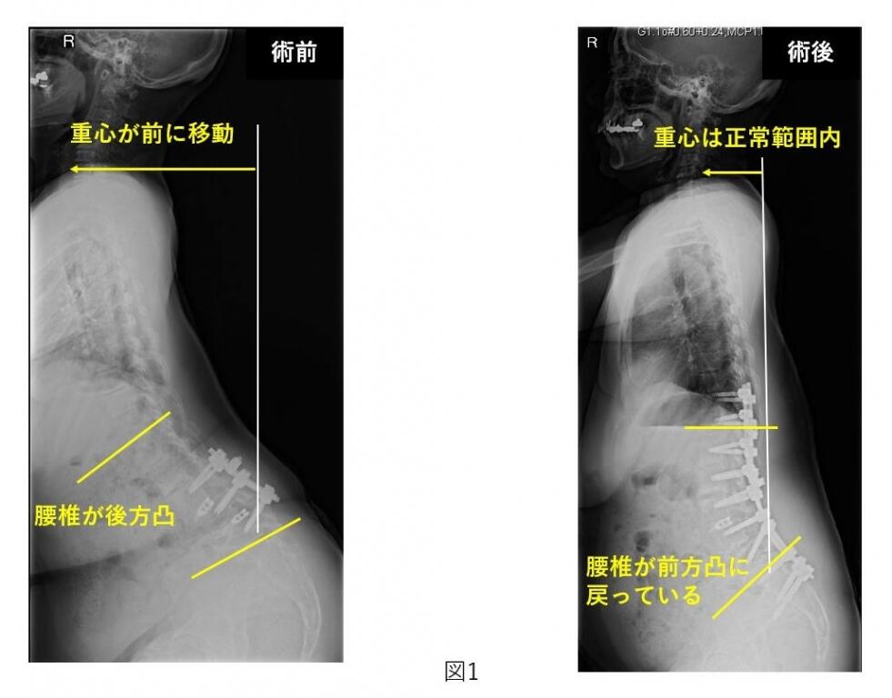 側弯症 39度➡︎34度に改善&腰痛改善50代女性・コルセットなし 側弯症改善ヨガ側弯症改善ヨガを開催しています出張ヨガKIKI主宰喜多貴子