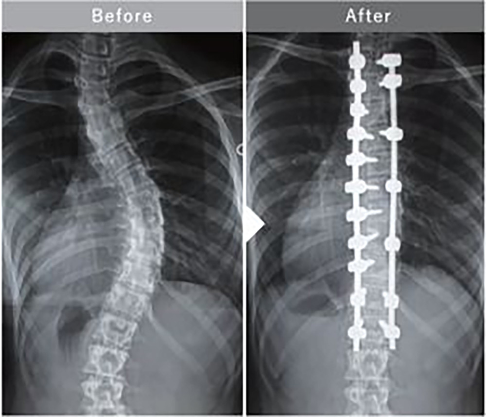 脊柱側弯症 - 長庚記念病院