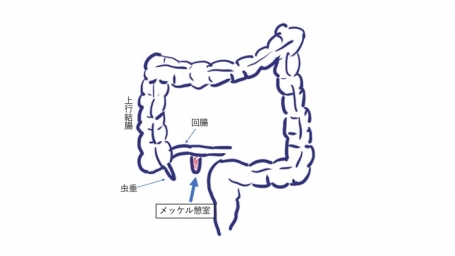 メッケル憩室がん」の初期症状をご存じですか？ 早期発見のポイントを併せて医師が解説メディカルドック