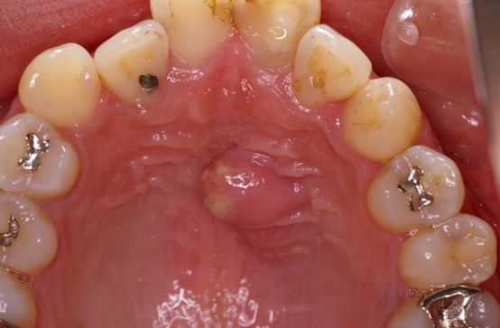子供の外傷歯の症例 ふじみ野市ふじみ野駅近くの歯医者 歯科- ふじみ野きくち歯科クリニック