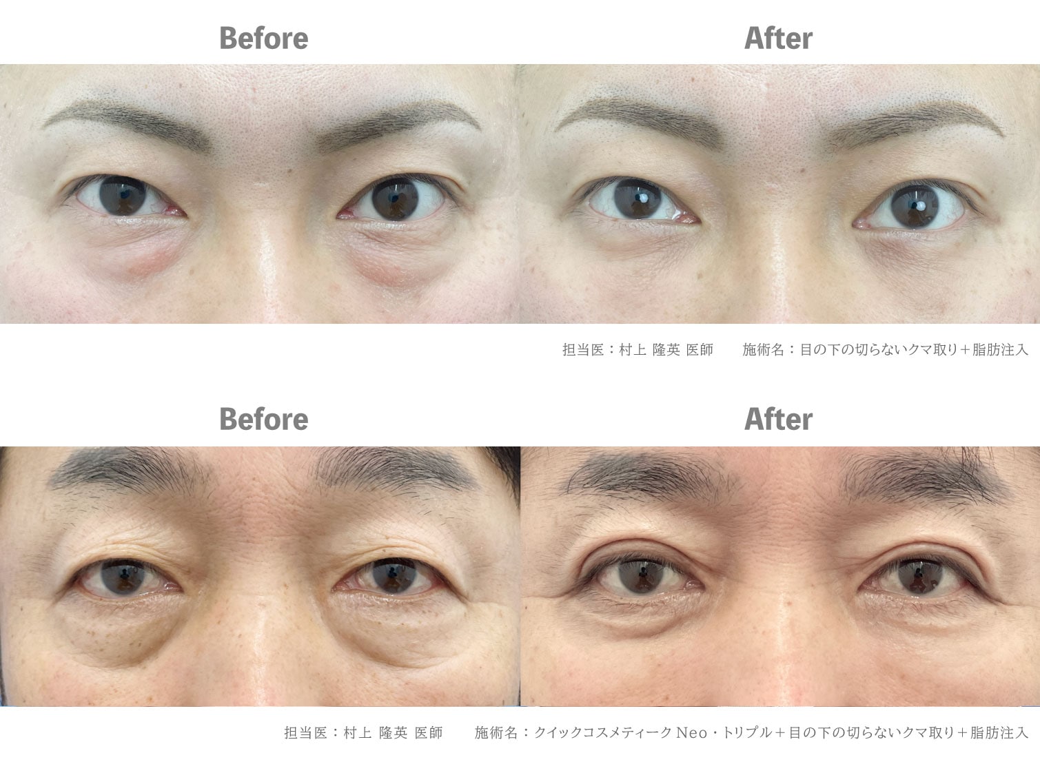 男性・メンズの目頭切開プレミアムメンズ美容整形外科なら湘南美容クリニック 公式