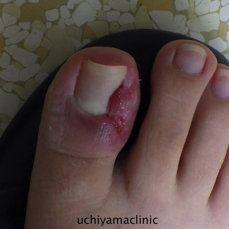 巻き爪化膿・陥入爪肉芽を自分で治すには？大田区大森・大木皮膚科