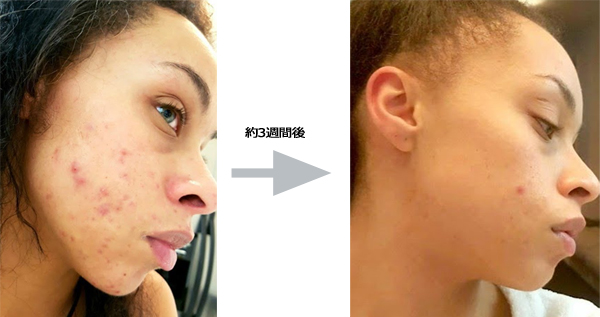 ニキビ跡やシミが気になるならこれ！, ニキビ跡って気になるよね、、, 見たくないニキビ跡にライトをつける💡, 「ザ・アルファアルブチン2ニキビ跡ケアセラム」, 紫外線による肌ダメージケアや, まだらな肌キメケアにも最適ദ്ദി ˃ ᵕ ˂, シミやトラブル跡発生の始まりから,たった4週間でケアできちゃう！？, 透明感のあるお肌を目指そう☺️, ↓Qoo10で購入できるよ↓,