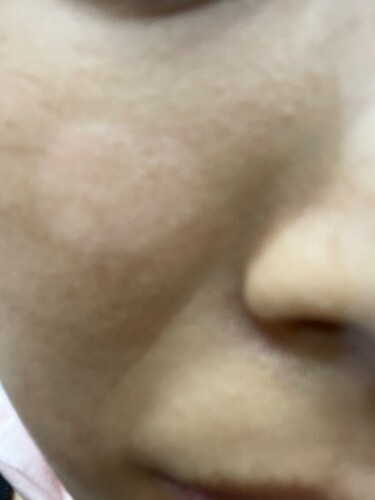 シミ肝斑治療外来 のシミ症例今日はシミのコンビネーション治療の症例のご紹介です。施術詳細・ケミカルピーリング3回 ・フォトRFオーロラ10回 ・肝斑レーザートーニング10回 ・全顔脱毛4回 ・高濃度ビタミンC点滴17回副作用発疹、痛み、腫れ、発赤