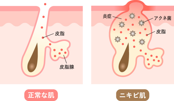 人中にニキビができる原因とは？即効性のある治し方を解説！ハダメディア by BIHADADO.TOKYO