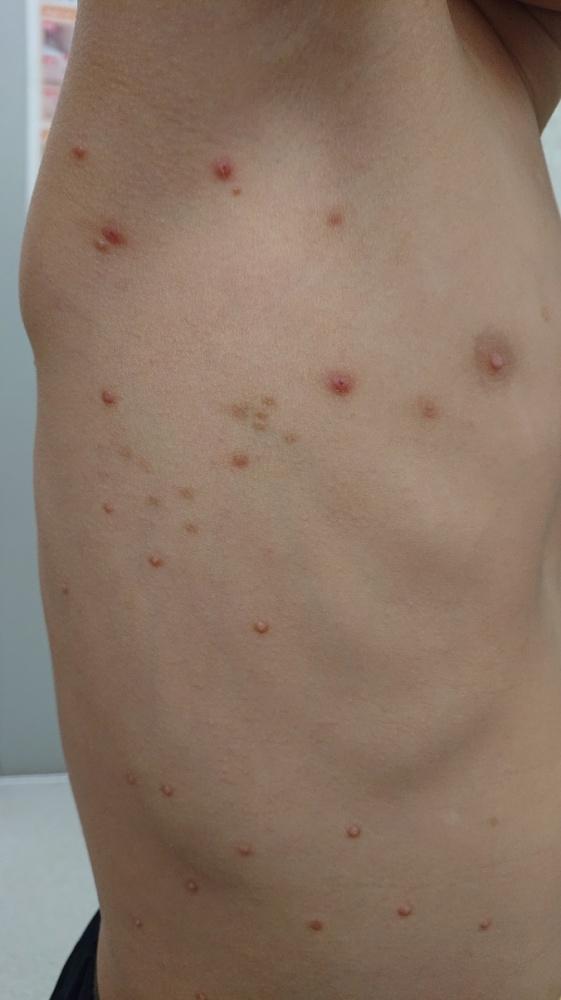 水いぼの治療しむら皮膚科クリニックのブログ