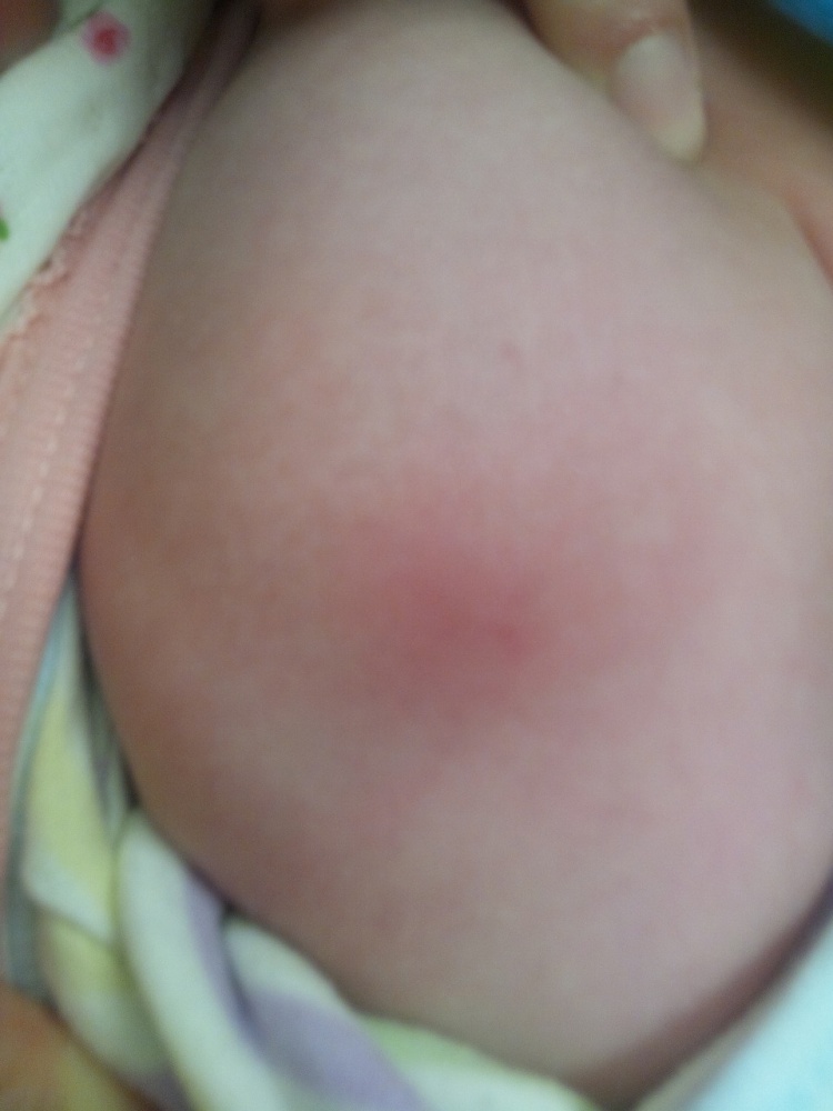 インフルエンザ予防接種後に腫れる、かゆい なぜワクチンで副反応が起こるのか予防接種・ワクチンAll About