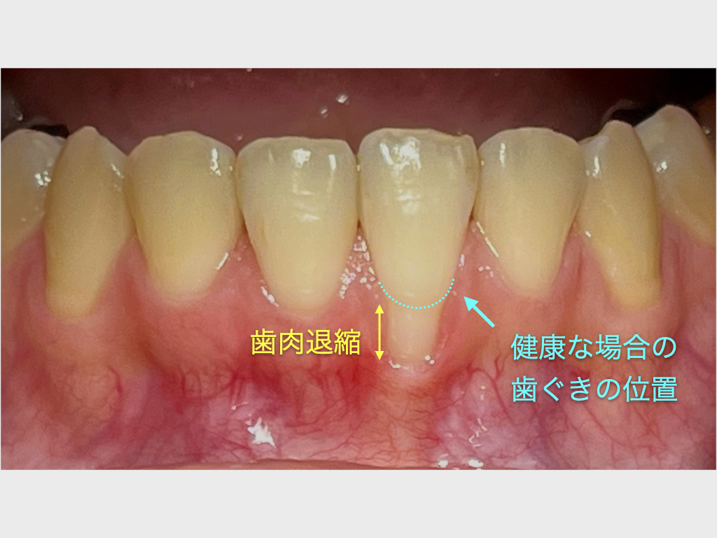 症例 矯正治療による歯茎下がりを歯茎の移植で改善目白・下落合の歯医者目白マリア歯科