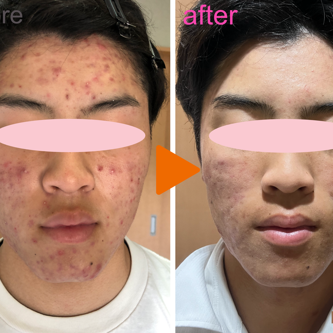 ご新規様・15才高校生・ニキビ、ニキビ跡大阪・谷町四丁目・天満橋・グリーンピール専門サロン Brise Doux ブリーズドゥース