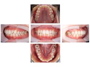 歯科のお仕事完全マニュアル 第３章 患者さんの情報 STEP４ 口腔内写真５枚法の撮影│歯科スタッフ向けメディアdStyle ディースタイル