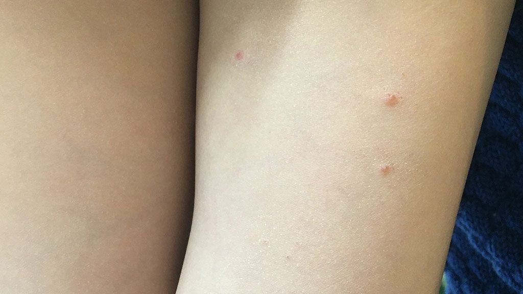 水いぼ 伝染性軟属腫写真で見る「子どもの病気」 - みやけ内科・循環器科 総合内科のアプローチ