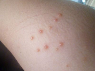 水いぼ 伝染性軟属腫の治療 新田皮膚科形成外科足立区新田皮膚科・小児皮膚科・形成外科