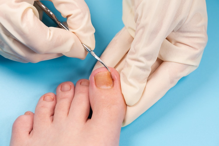 巻き爪化膿・陥入爪肉芽を自分で治すには？大田区大森・大木皮膚科