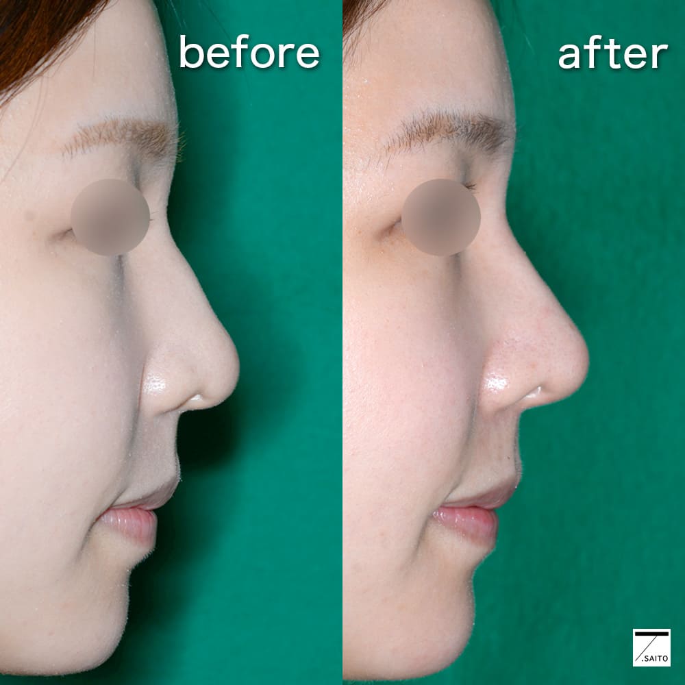 小鼻を小さくするためのメイク・筋トレ・スキンケアの方法