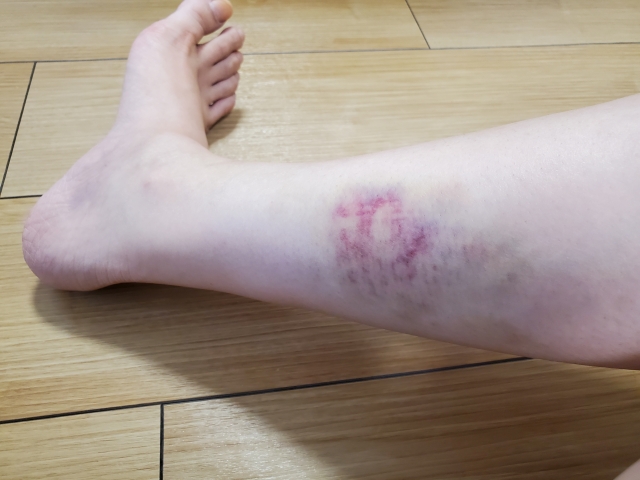 高齢者の表皮剥離や皮下・内出血などの病気トラブルの原因と対処法について解説介護ソフト・介護システムならリハブクラウド