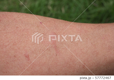 松谷医院有田川町 内科 循環器内科虫刺されの注意喚起有田川町内科虫刺され