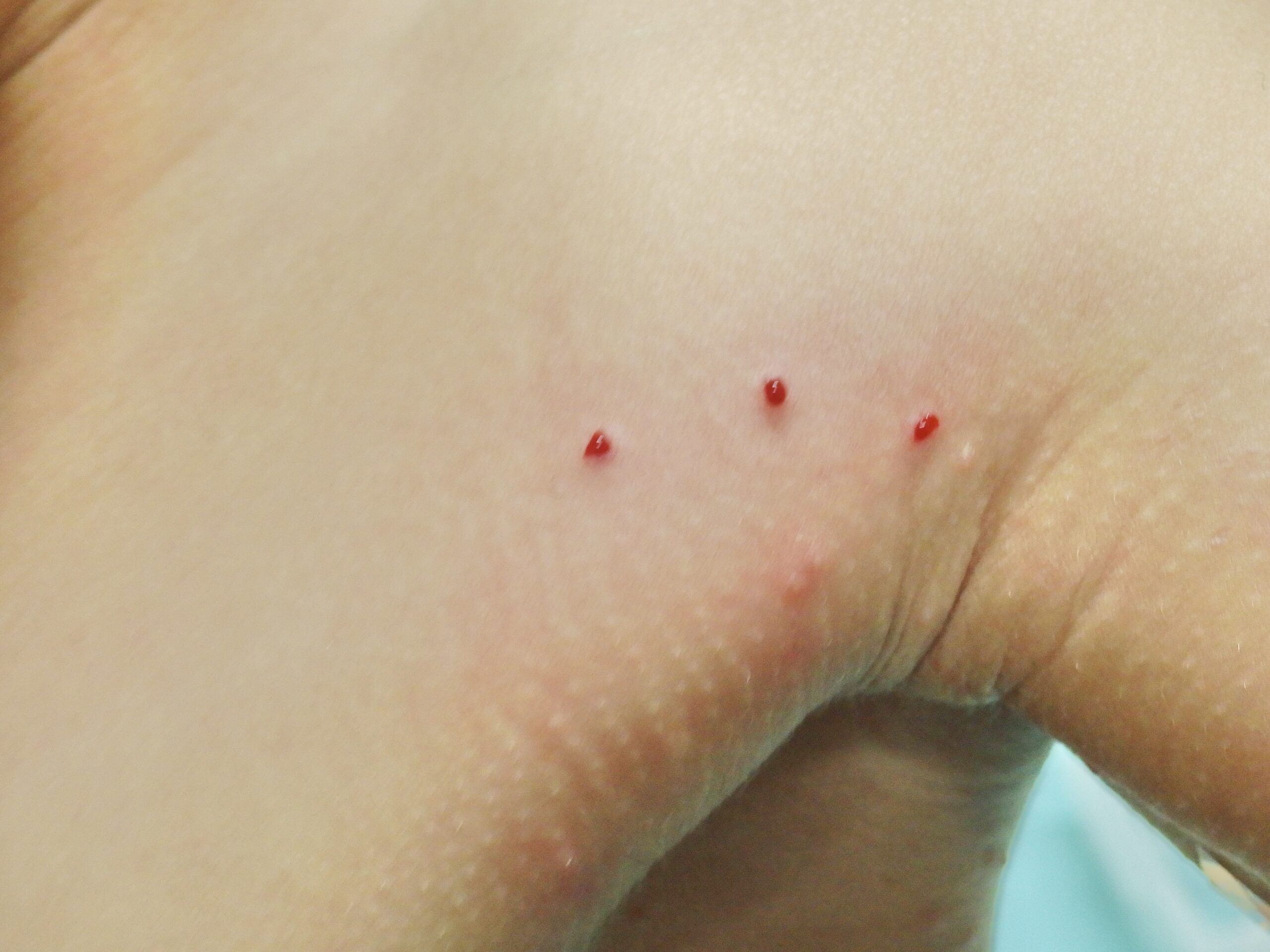 子供に多いとびひ豊橋のまひろ皮ふ科クリニック