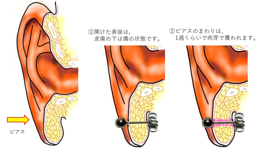 ピアスケロイドの治療②しむら皮膚科クリニックのブログ