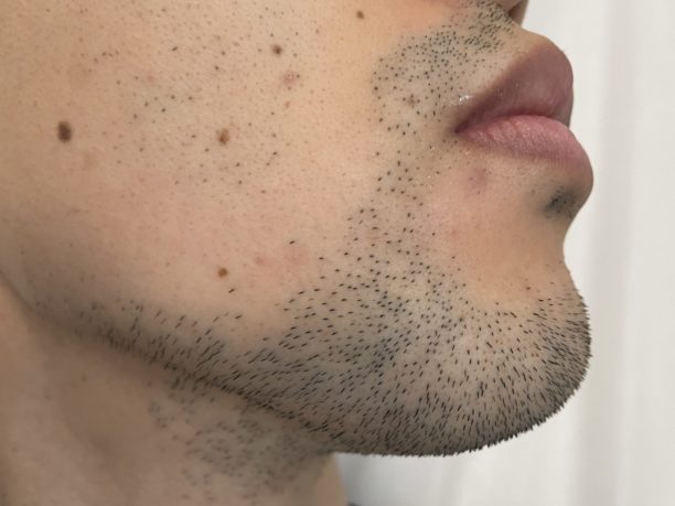 ABランクヒゲ濃いめ男がケノン”プレミアムカートリッジ”で髭脱毛してみた！アパレルにスパイした元”下半身デブス上半身華奢男”が解き明かす、スタイルアップの秘密