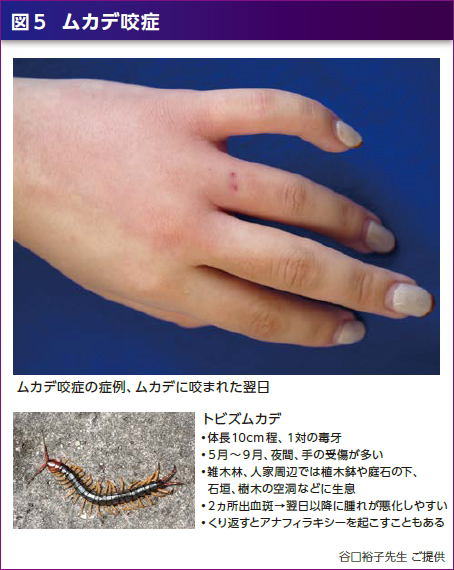 虫刺され、腫れがひどいけど薬はいる？ステロイドは効くの？ 医師監修- オンライン診療ならウチカラクリニック