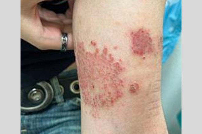 医師監修・作成 帯状疱疹の痛みのピークはいつまで？痛み止めの薬などの治療法についてMEDLEY メドレー