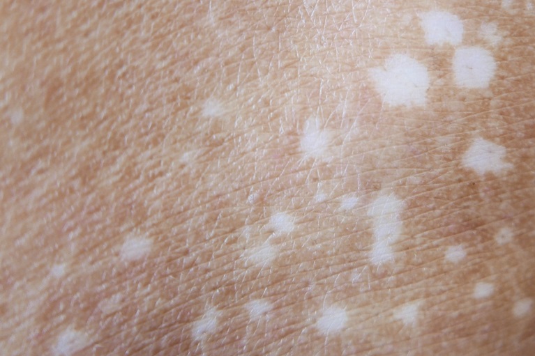 何が白斑を悪化させるのか？ – dermahealer.jp