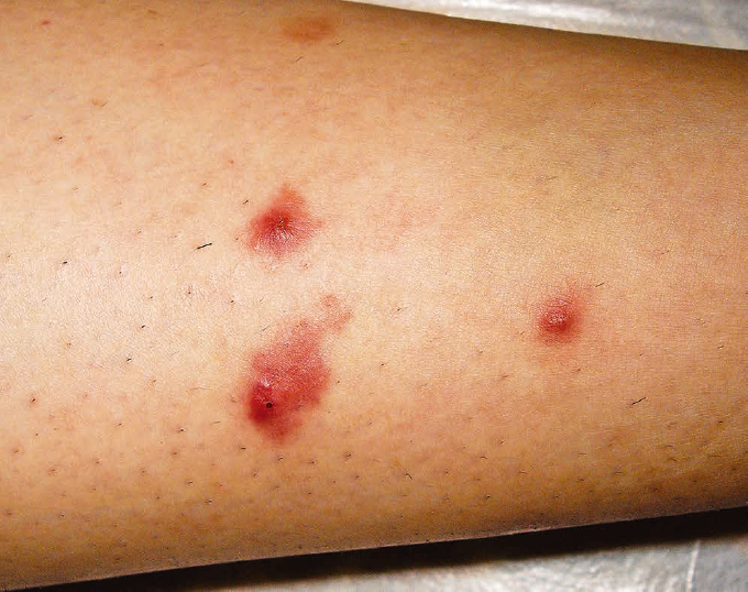 虫刺症 虫刺され- つくば・土浦鶴町皮膚科クリニック