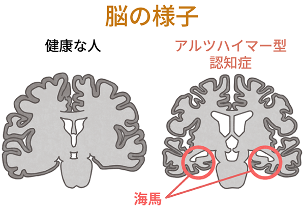 海馬とは？ - 佐藤病院 精神科・内科