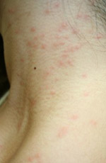 毛虫皮膚炎埼玉県皮膚科医会