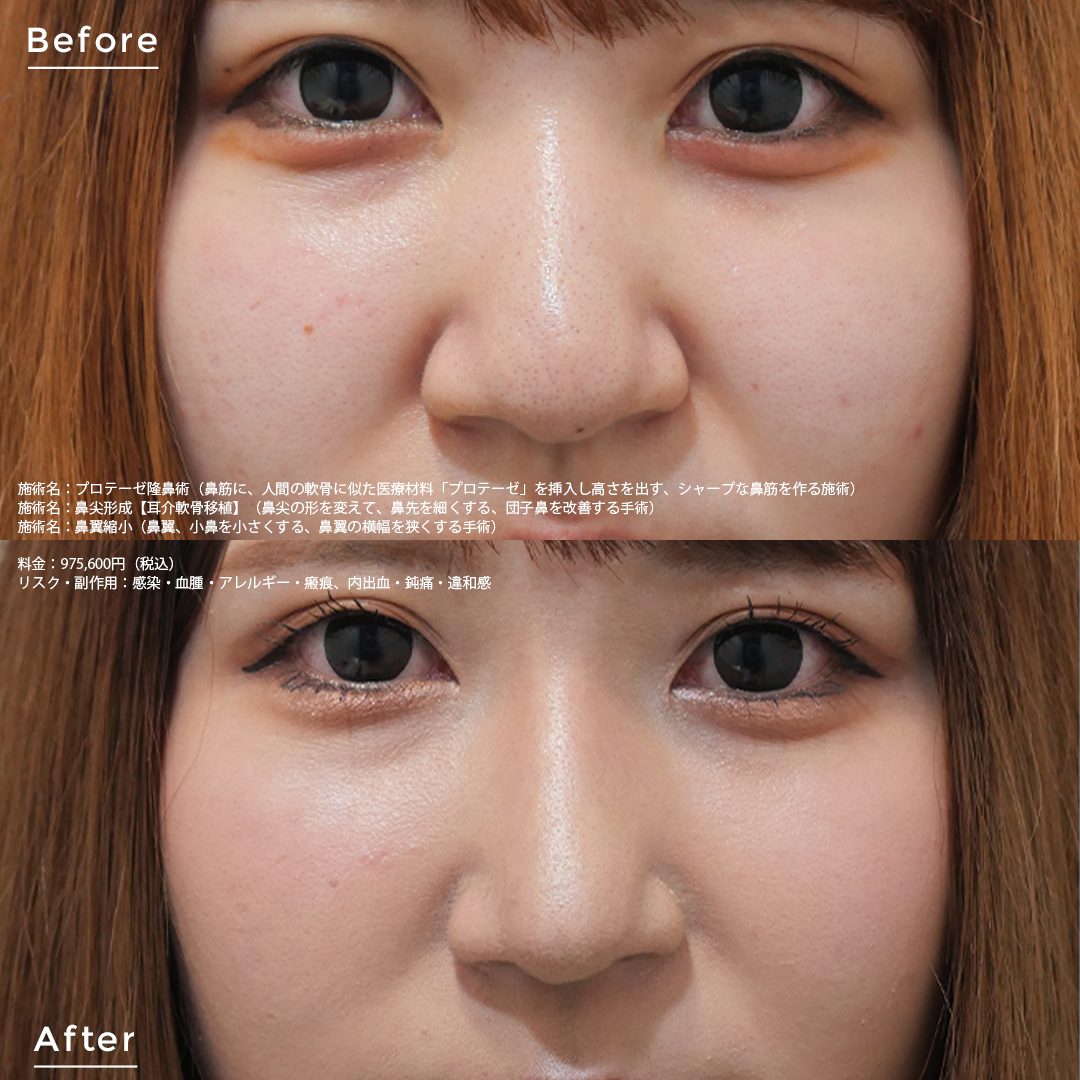 小鼻を自力で小さくする方法とは？医師が解説金沢の美容外科はeクリニック