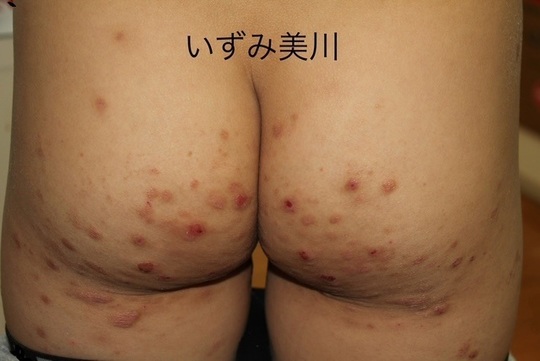 皮膚病の写真素材 - PIXTA