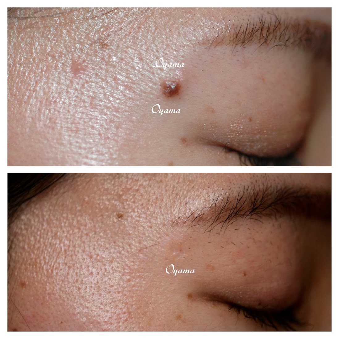 切らないいぼ・ほくろ除去美容皮膚科なら湘南美容クリニック 公式