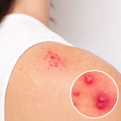 赤いブツブツの対処法クロマイ-N軟膏第一三共ヘルスケア