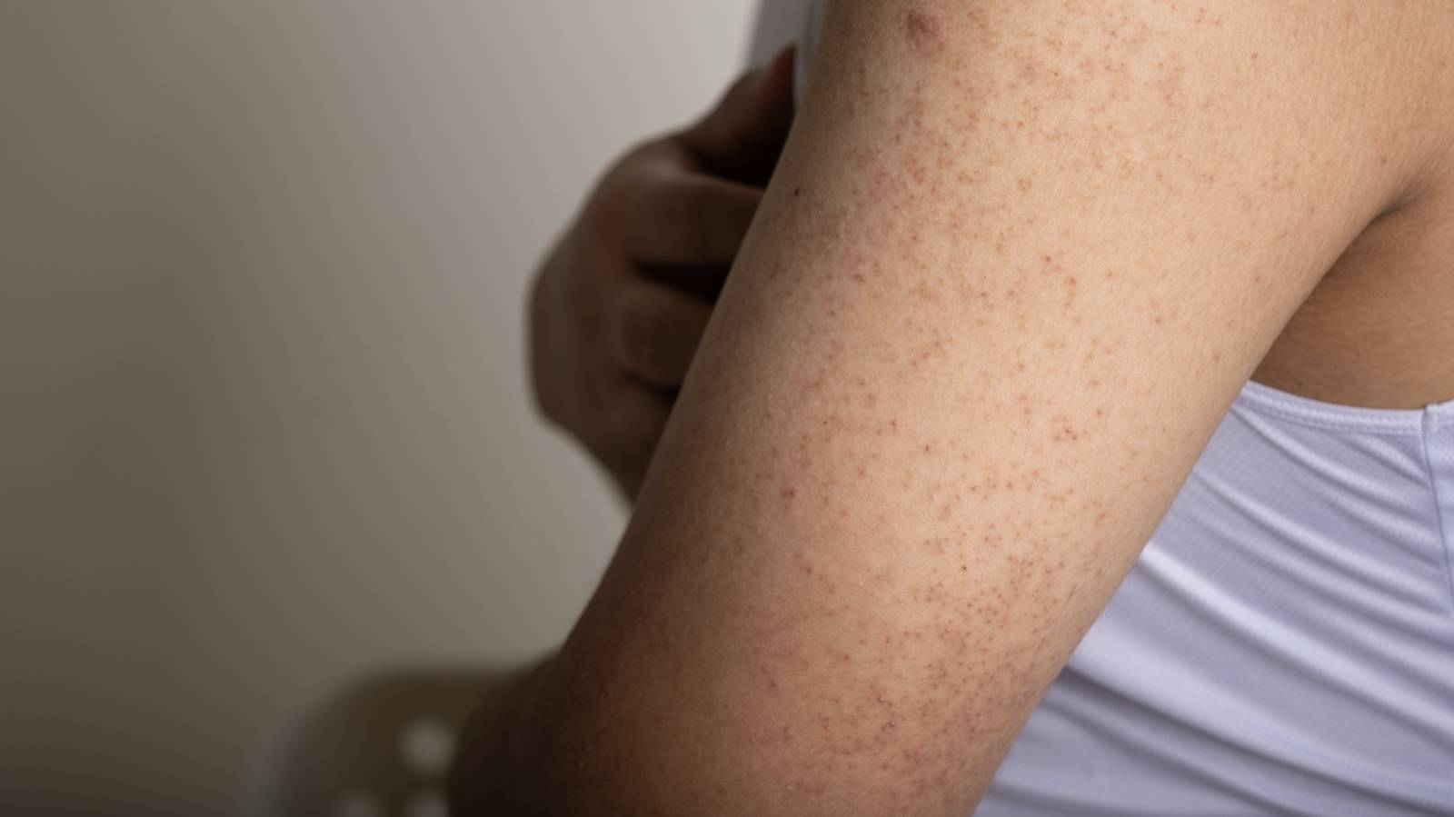 腕に赤い斑点は「肝臓の病気」サインの「クモ状血管腫」かもMedicalook メディカルック