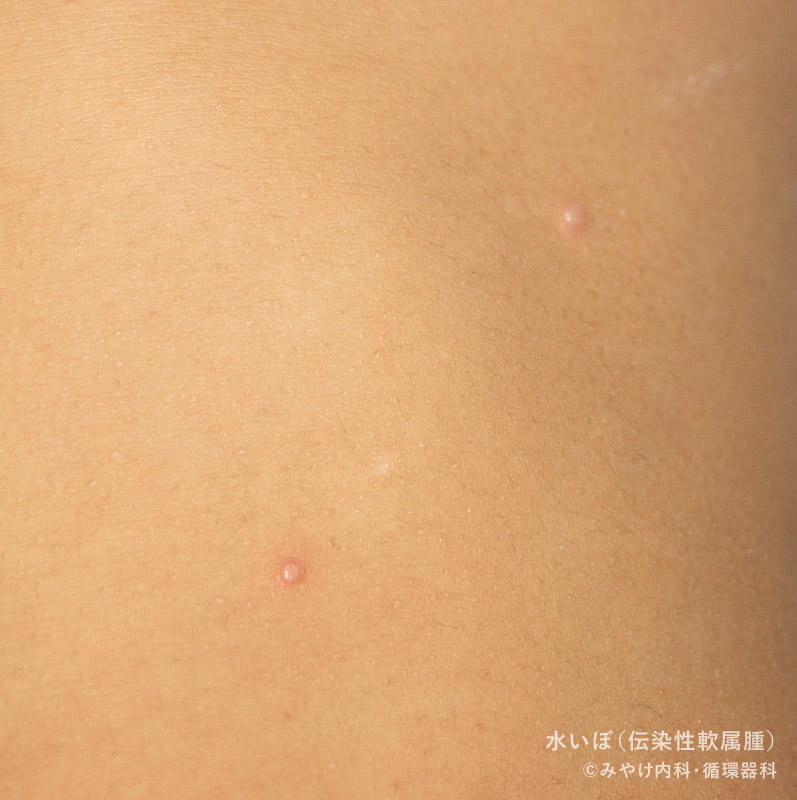 水いぼ那珂川市の小児科・内科・眼科『江副クリニック』福岡県那珂川市