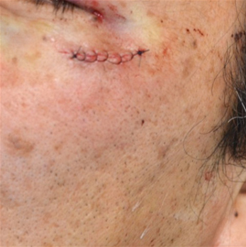 これは重症ニキビの跡のケロイドです ニキビ跡で多いものはクレーターや凹みで残念ながらこれは保険が通りません😔ですが、フェイスラインや顎にできることの多い肥厚性瘢痕またはケロイドと呼ばれる皮膚にできる赤褐色の硬い結節は保険で治療することができます🙌 治療