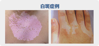 アトピー性皮膚炎ひふのクリニック人形町