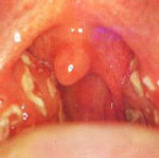 扁桃腺炎 « 病気の解説 うめはなメソッド梅華会グループ 耳鼻咽喉科・アレルギー科