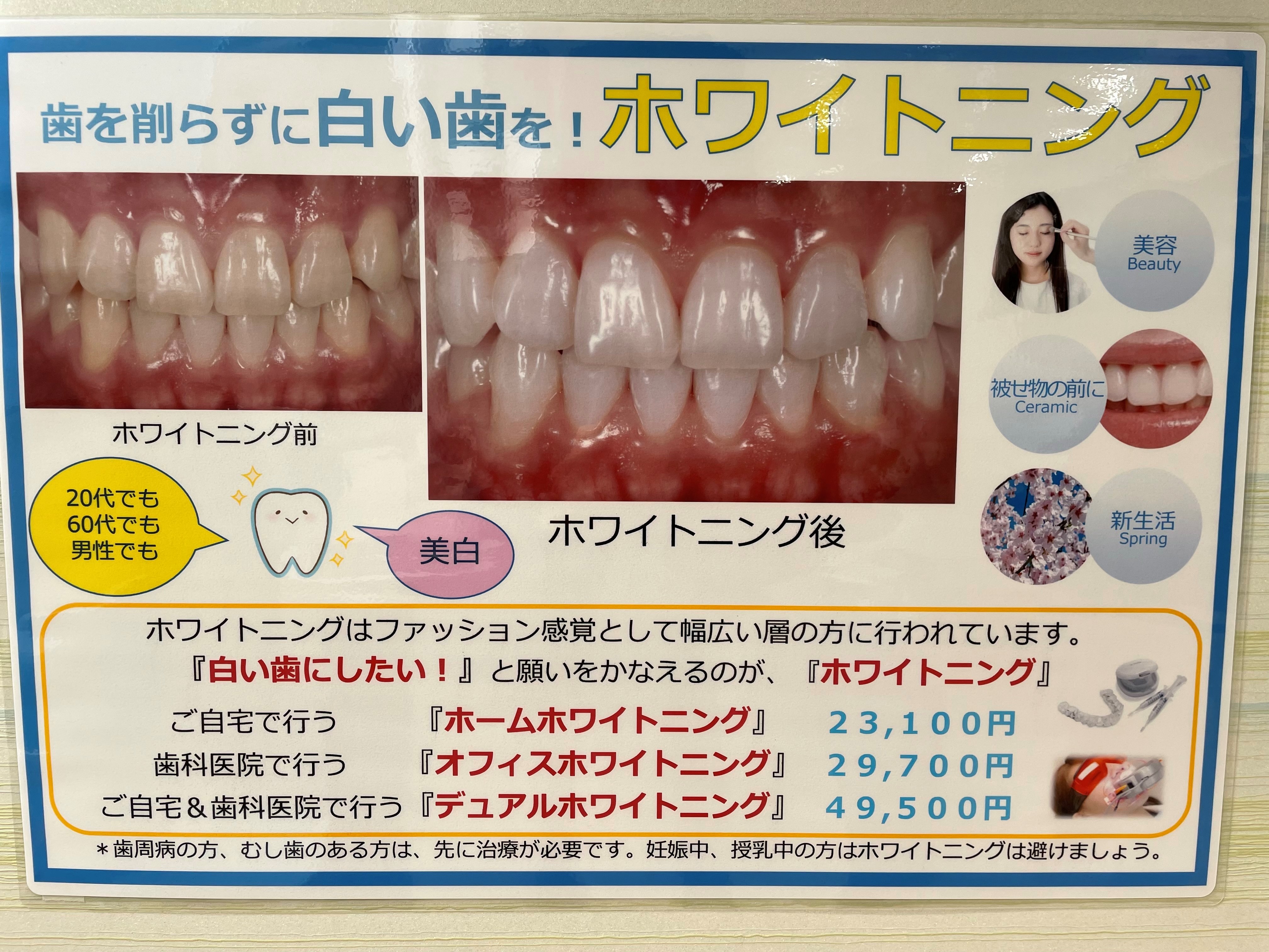 審美・ホワイトニング - 福岡市の歯医者つきやま歯科・矯正歯科 いじり本院あなたの歯を守る歯科医院