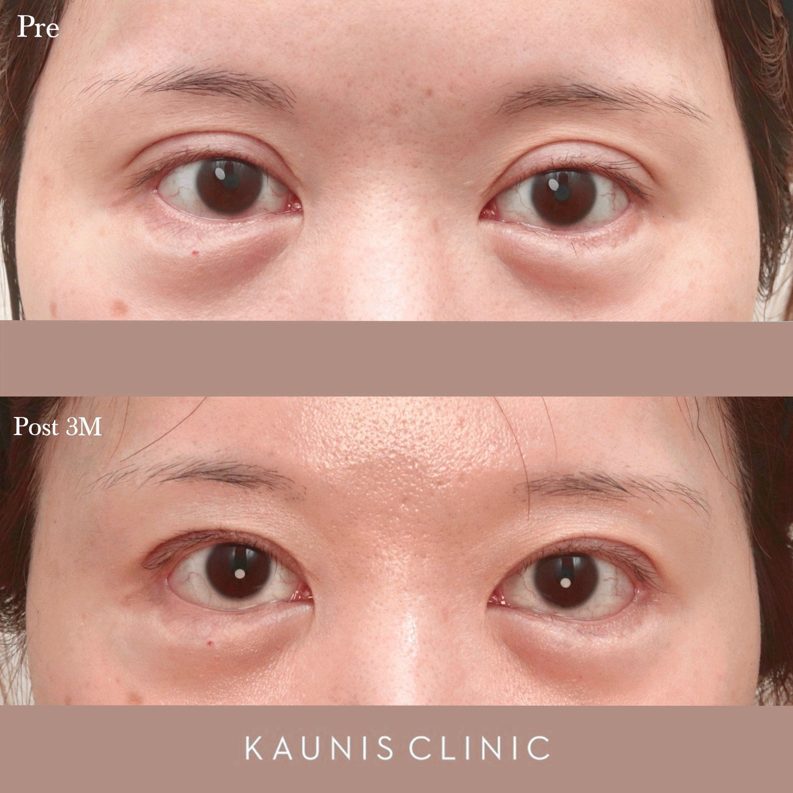 二重まぶた・末広型と平行型の違い画像あり横浜で働く美容外科院長の美容整形ここだけの話ブログ