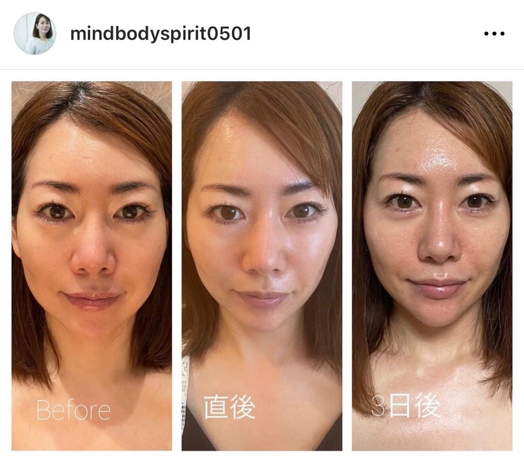 レチノールクリームはほうれい線の改善に効果的なの？エイジングケアを本気で学ぶ情報サイトナールスエイジングケアアカデミ