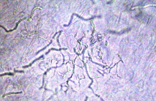癜 風 関 連 疾 患
