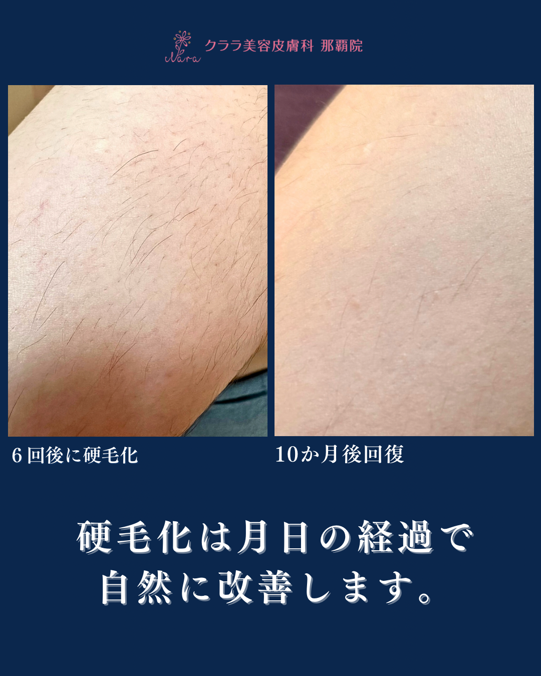 脱毛トラブル 「こんな業者はダメ！」消費者問題に詳しい弁護士が解説 脱毛は若者だけではない 中高年に人気の「介護脱毛」もFNNプライムオンライン