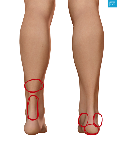 アキレス腱滑液包炎 - 08. 骨、関節、筋肉の病気 - MSDマニュアル家庭版