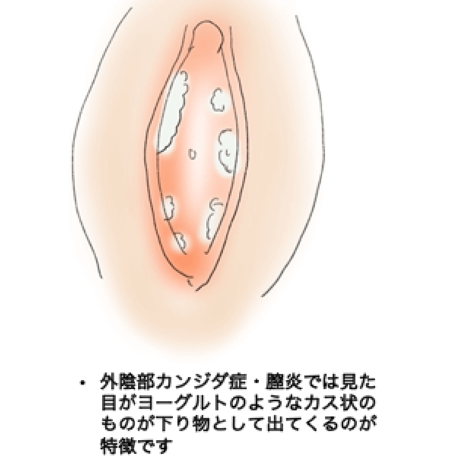 カンジタ症 – お知らせ高木皮膚科・漢方皮膚科