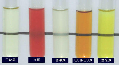 ミオグロビン尿症が原因と思われる急性腎不全病理検査の玉手箱 - 楽天ブログ