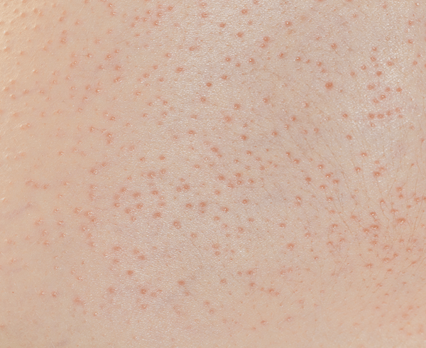 ガサガサ、乾燥しているかかとケア👨🏻‍⚕️かかとのガサガサや乾燥、やすりなどで削ったり 皮膚を無理やりめくったりしていませんか？🦶💦間違ったケアをすると、逆に悪化することがあるので 正しくケアしましょう☝️ ラインナップはこちら👇 ✓はじめに ✓削っては